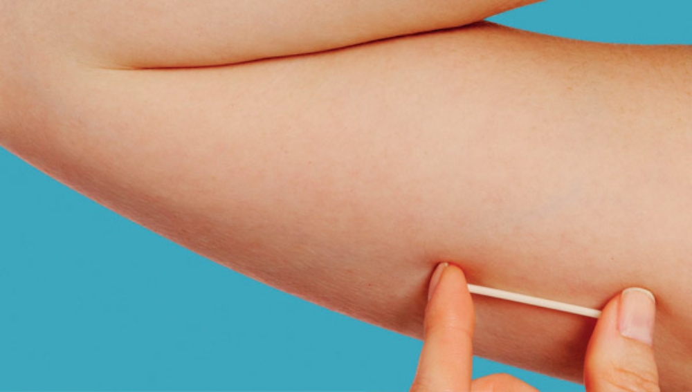 Implanon e radioterapia IMRT passam a ser oferecidos pelos planos de saúde